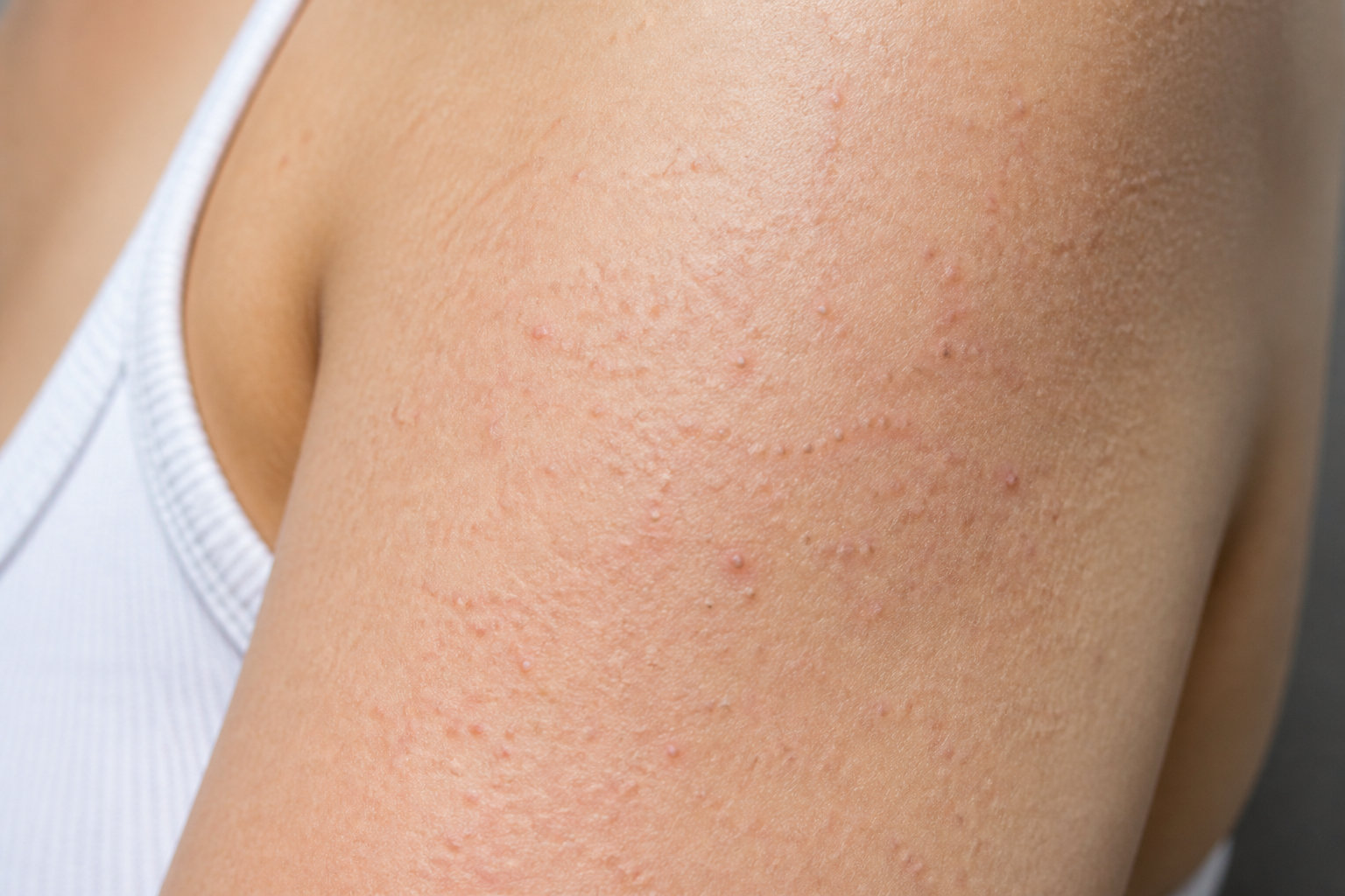 Comprendre la kératose pilaire pour mieux traiter votre peau